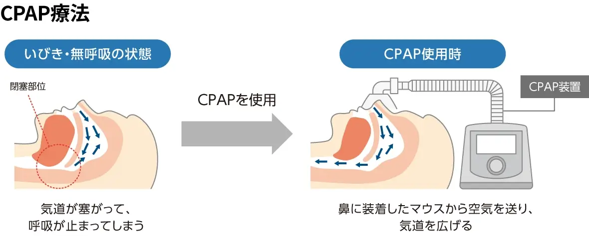 日本国内で普及しているCPAP療法