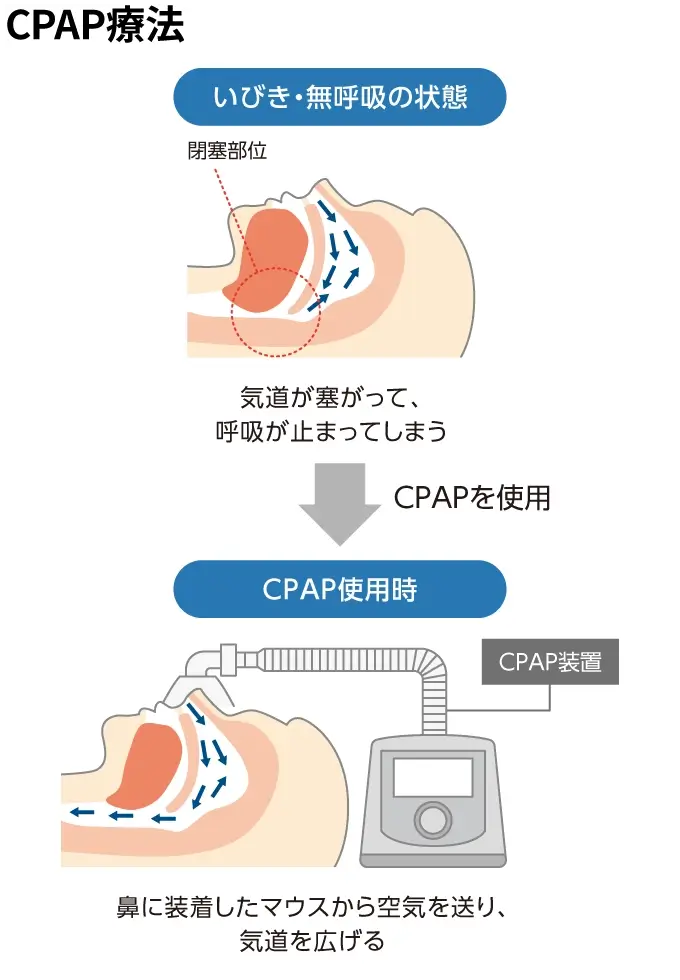 日本国内で普及しているCPAP療法