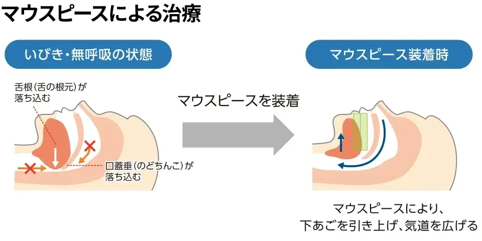 日本国内で普及しているCPAP療法