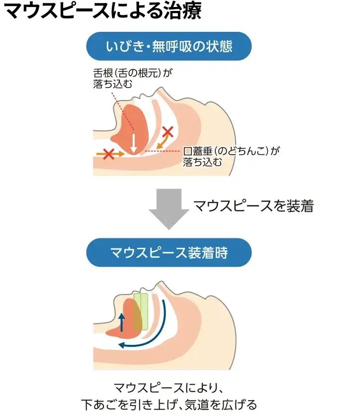 日本国内で普及しているCPAP療法